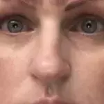 A botched microblading procedure left this woman with 4 eyebrows