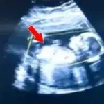 Ectopic pregnancies are rare but potentially fatal.