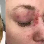 Eczema 