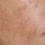 4 habits that cause dark spots on skin.