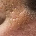 Atrophic Scarring: What It Is and How To Treat It