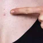 Chest acne: Why we get it and how to get rid of it