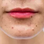 Cystic Acne: What It Is And How To Treat It