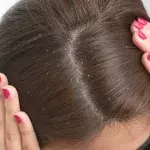 Dandruff
