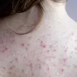 Everything You Need To Know About Back Acne 