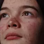 A Foolproof Guide To Using Spironolactone For Acne