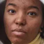 How To Eliminate Post-Inflammatory Hyperpigmentation
