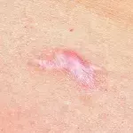 Hypertrophic Scars Explained: Why They Occur and How To Treat Them