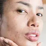 These products will prevent acne scarring from happening to you 