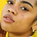 Understanding Your Acne Scars and How To Treat Them