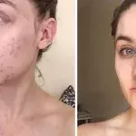 This Woman Stopped Washing Her Face For Six Months And Cured Her Acne