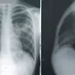 COVID x rays