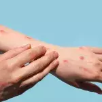 US infected with 1/3 of monkeypox cases worldwide, but the virus isn’t the only thing that’s spreading 