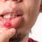 Cold sore