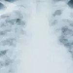 COVID pneumonia