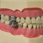 The device only allows the mouth to open by 2mm