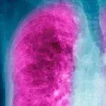 Lung cancer warning signs