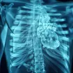 LVAD no heart beat Left Ventricular Assist Device