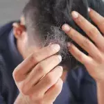 The real reason why men lose their hair more than women