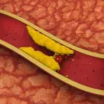 What is venous thrombosis, and do COVID vaccines cause it?