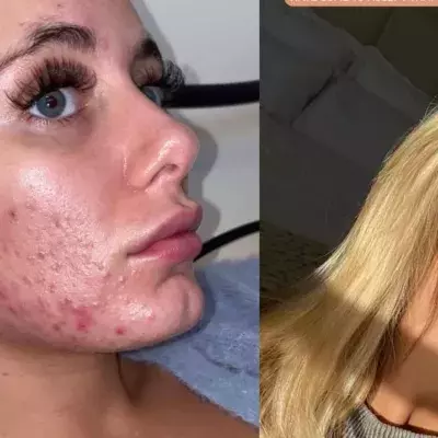 Love Island: Millie shares her acne battle transformation in a new YouTube video