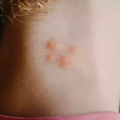 Shocking death of 19-year-old student following spider bite  