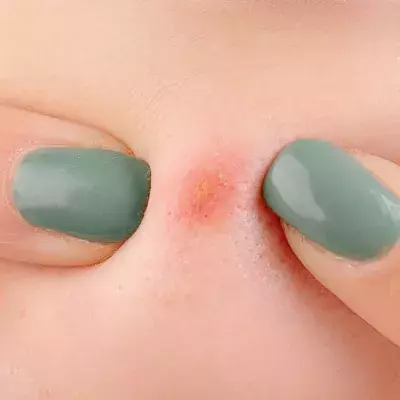 After 20 years, this woman finally gets rid of giant blackhead that was ruining her life