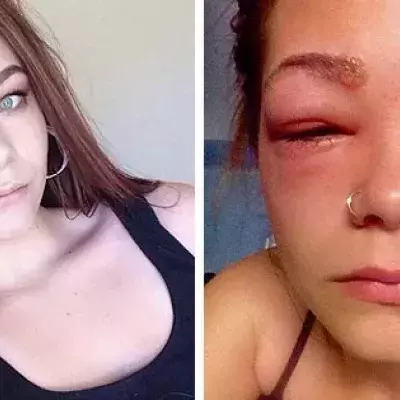 Allergic to dye