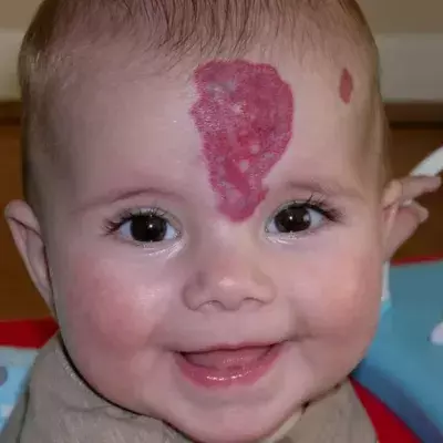Birthmark