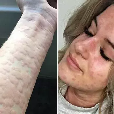 Canada cold allergy
