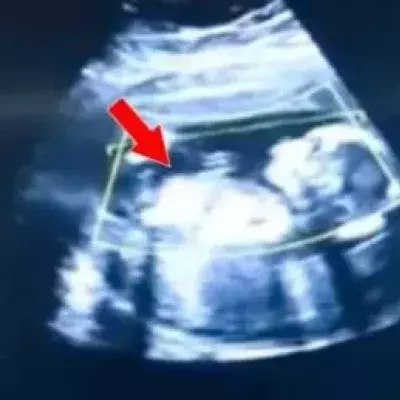 Ectopic pregnancies are rare but potentially fatal.