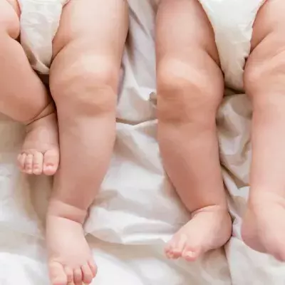 Exceptionally rare 'semi identical' twin babies have bewildered doctors 