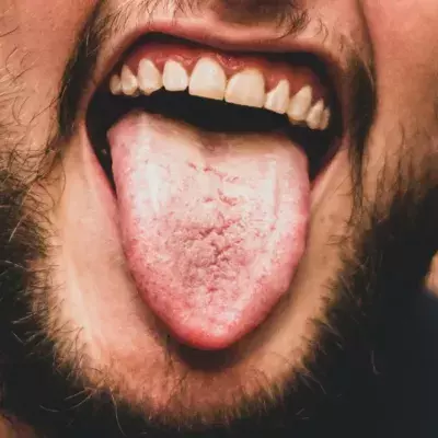 Hairy tongue: This man was diagnosed with this rare condition after his tongue turned green and hairy
