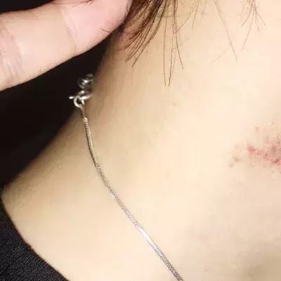 Love bite can cause stroke