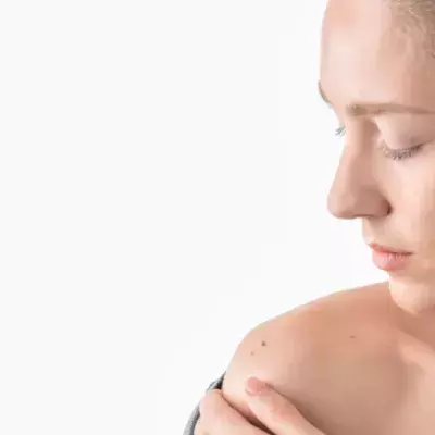 melanoma