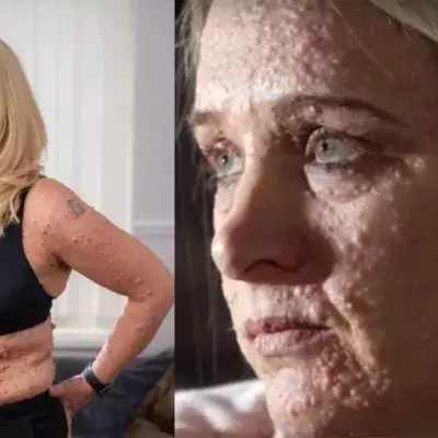 Skin disease