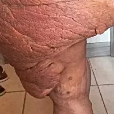 Tumours