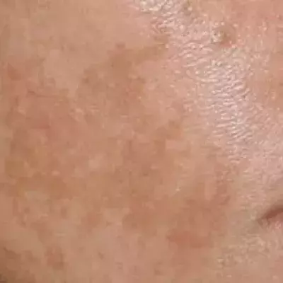 4 habits that cause dark spots on skin.