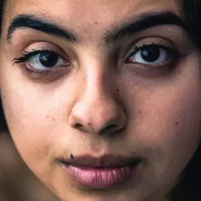 8 Amazing Home Remedies to get rid of Dark Spots