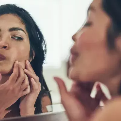 Acne vs Pimples, What’s The Difference?