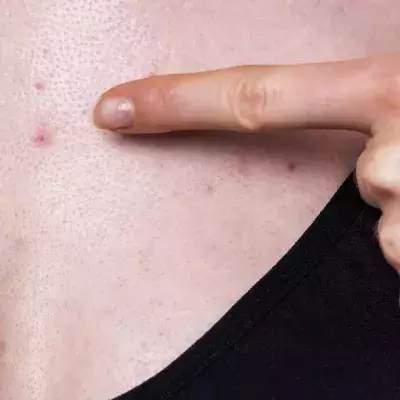 Chest acne: Why we get it and how to get rid of it