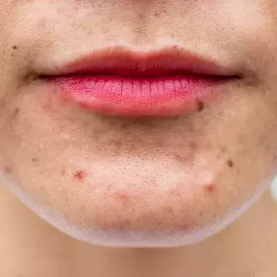 Cystic Acne: What It Is And How To Treat It