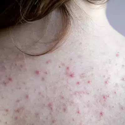 Everything You Need To Know About Back Acne 