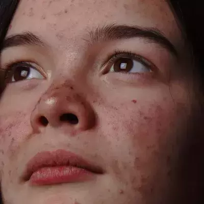 A Foolproof Guide To Using Spironolactone For Acne