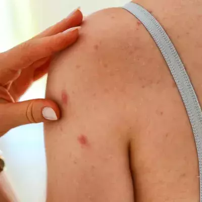 How To Conquer Body Acne
