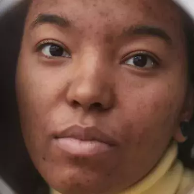How To Eliminate Post-Inflammatory Hyperpigmentation