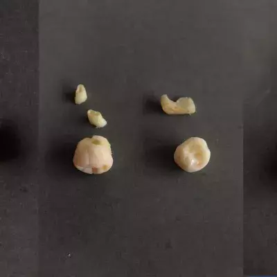 Human Teeth To Fight Against Elephant Poaching