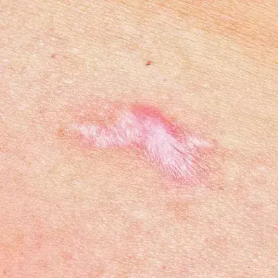 Hypertrophic Scars Explained: Why They Occur and How To Treat Them