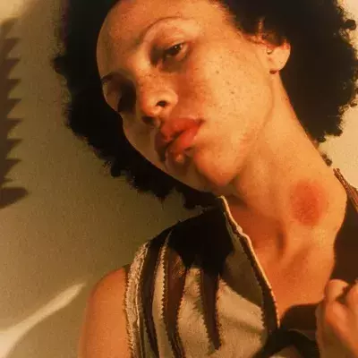 Six Ways To Get Rid of a Hickey That Actually Work — And Two That Don't