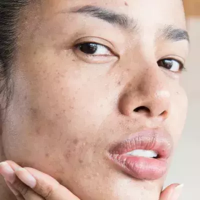 These products will prevent acne scarring from happening to you 
